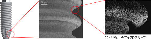 ノーベルバイオケア社製：インプラントの一例